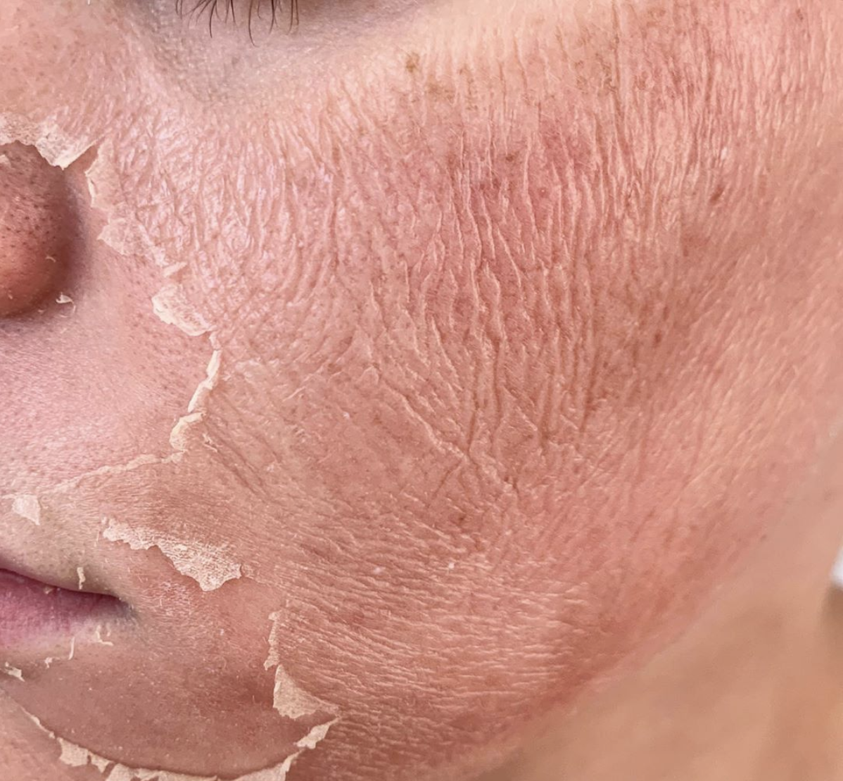 Facial Chemical Peels In Allen TX Face Peeling Treatments