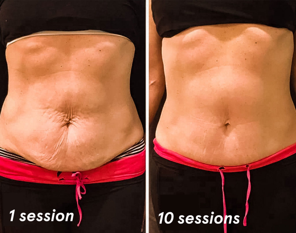 Body Sculpting Treatments In Allen Body Sculpting Sessions