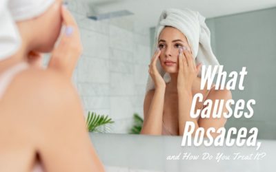 What Causes Rosacea, and How Do You Treat It?