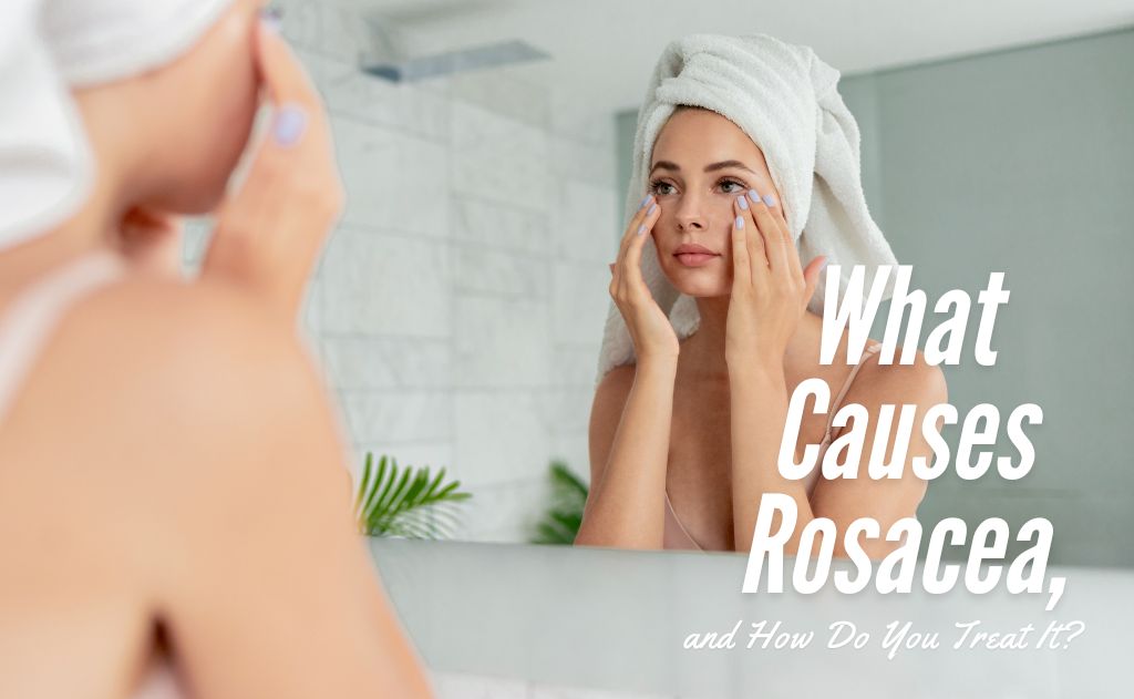 What Causes Rosacea, and How Do You Treat It?