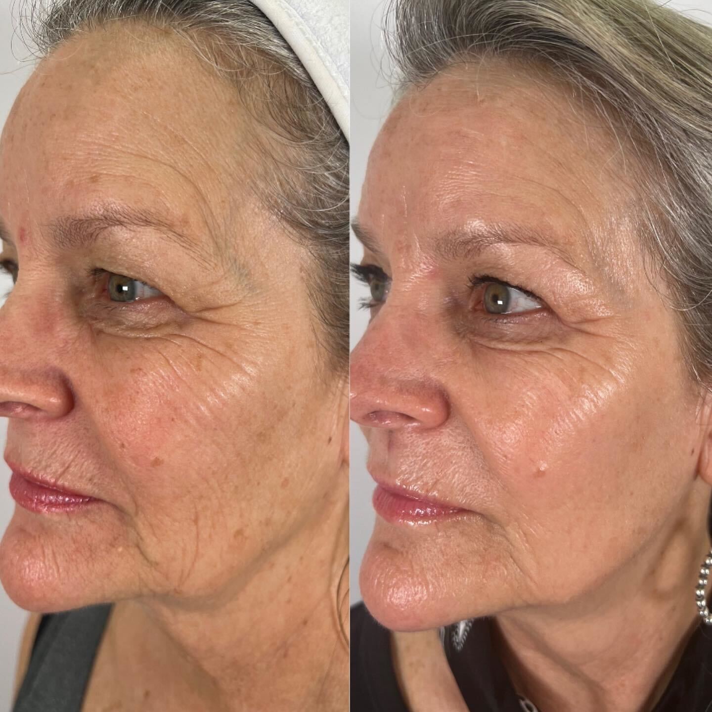 Reve Peel Boho Alternative Medical Spa